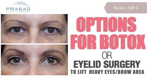 Botox Eyelid Lift
