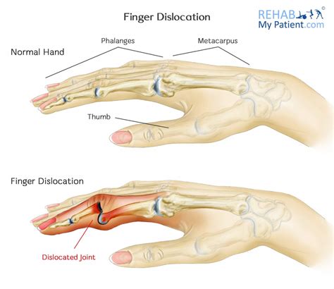 Finger Dislocation Rehab My Patient