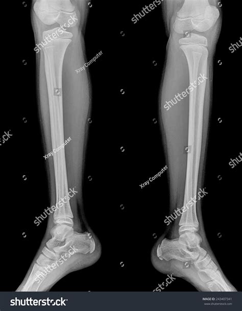 Detail Xray Child Leg Stock Photo 243407341 Shutterstock