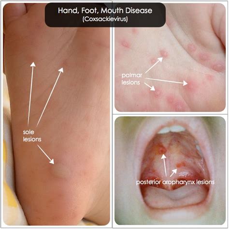 Viral shedding has been detected before, during, and after the appearance of clinical lesions in patients with recurrent oral symptoms, such as mild pharyngitis and erythema of the oral mucosa, occur with. The lesions are manifestations of hand-foot-and-mouth ...