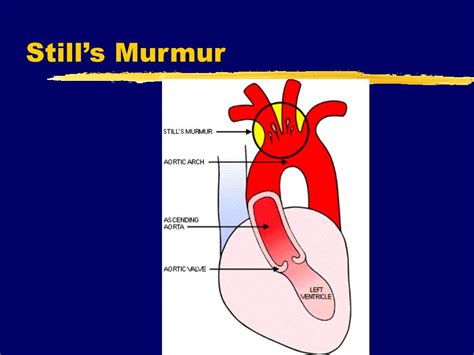 Pathologic Conditions That Can Cause Heart Murmurs Steve Gallik