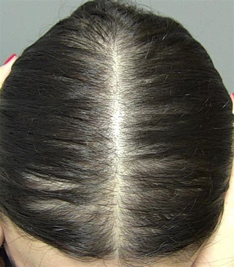 Alopecia Androgenética Br