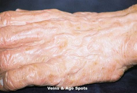 The Cause Of Brown Age Spots Natural Skin Care Brown Age Spots Age