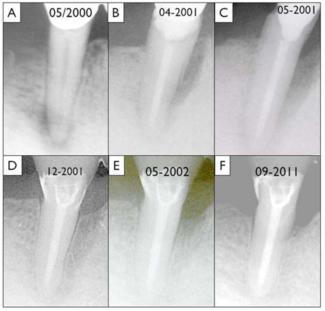 A description of clinical, radiographic, and histopathological features of two clinical cases. Regenerative Treatment of a Cemental Tear Using Enamel ...