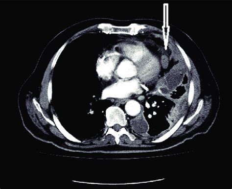 An Enlarged Pericardial Lymph Node White Arrow It Is One Of The Rare