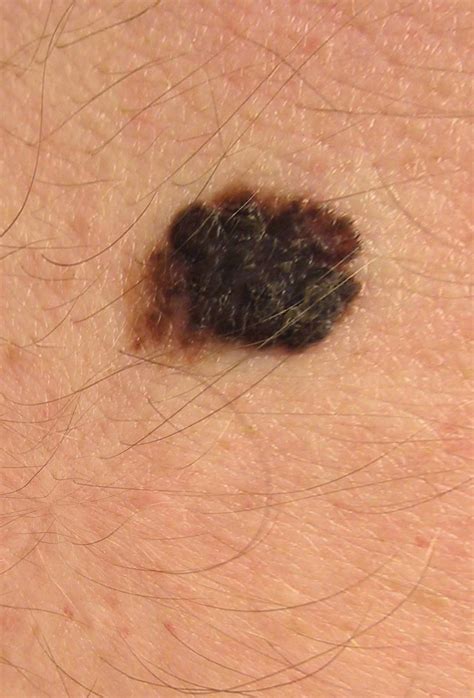 Hundreds Of Cancer Possibilities Arise From Common Skin Mole Mutation