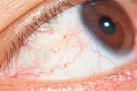 Capillaries In The Eye Flickr Photo Sharing