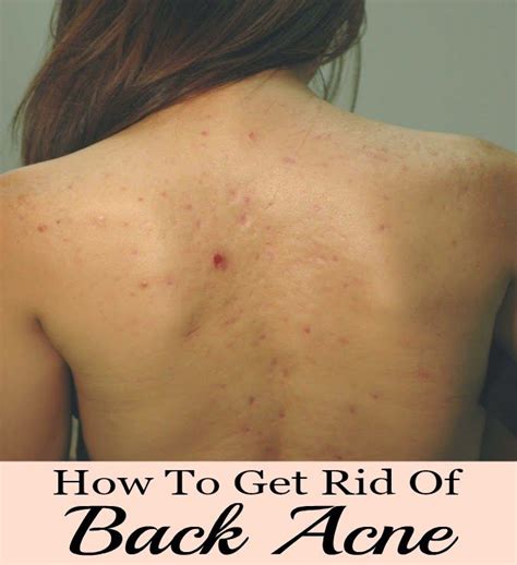 How To Get Rid Of Back Acne Beauté