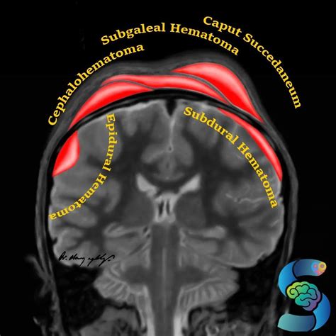 Epidural Hematoma Pediatric Radiology Pediatrics Instagram Profile