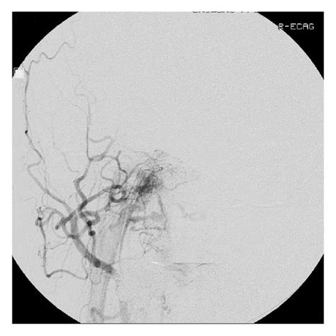 Three Dimensional Digital Subtraction Angiography Revealed