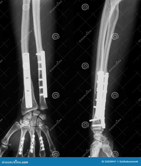 X Ray Image Of Broken Forearm Stock Photo Image 53838941