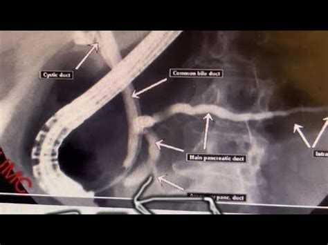 Endoscopic Retrograde Cholangiogram Pancreatography ERCP YouTube