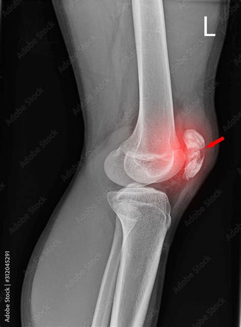 Knee Joint X Ray Fracture Kneecap Stock Foto Adobe Stock