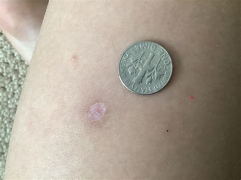Dont Know If This Really Belongs Here But My Brown Recluse Bite Has