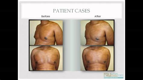 Gynecomastia Before And After Surgery Youtube
