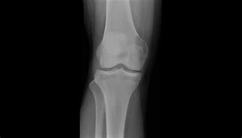 Ortho Dx Progressive Knee Pain In A 41 Year Old Woman Clinical Advisor