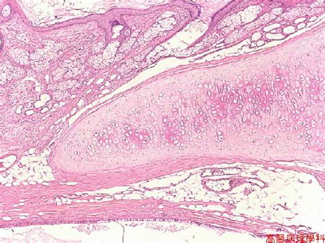 Kmu Pathology Lab《slide 38》dermoid Cyst Ovary