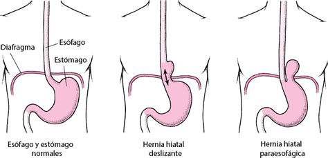 Hernia De Hiato Trastornos Gastrointestinales Manual Msd Versión