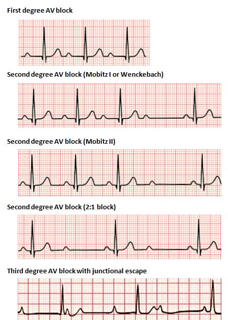 Third Degree 3rd Degree Heart Block Ecg Photos Idea