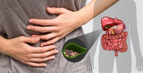 Gallstones Symptom Causes Type Risk Factors And Complications