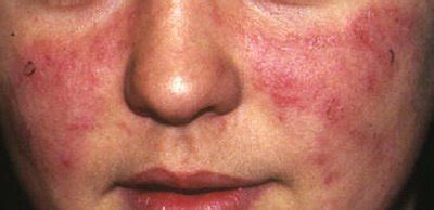 Systemic lupus erythematosus, or lupus, is a chronic autoimmune disease. LUPUS | SkinDerma