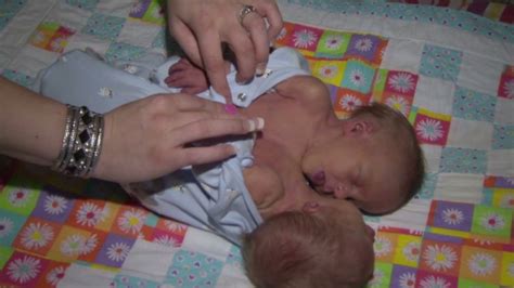 Conjoined Twins Share Breastbone Heart Video
