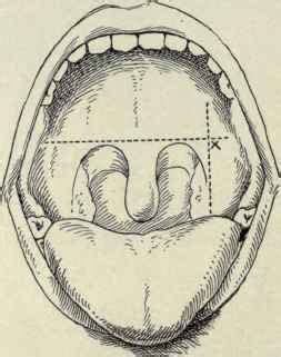 7 the mallampati score has been modified by friedman et al., who studied the value of this type of assessment in patients with. The Mouth And Throat. Part 3