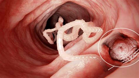 10 Early Signs Of A Tapeworm To Never Ignore