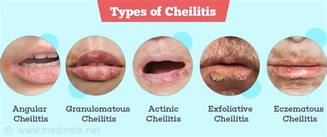 What Is Actinic Cheilitis Health Life Media