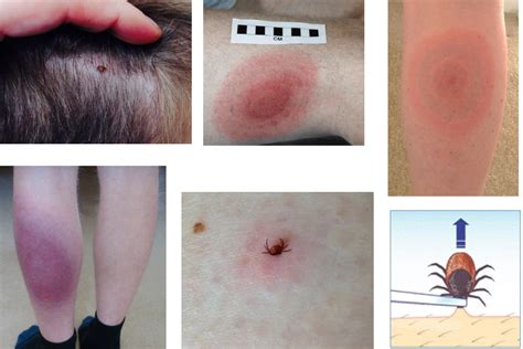 Lyme Disease Signs And Symptoms Govuk