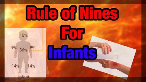 The Rule Of Nines Explained Infant Version Youtube