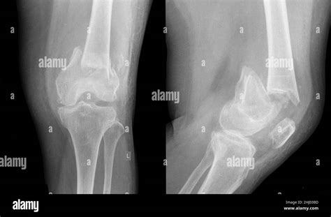 Fractured Leg X Ray Stock Photo Alamy