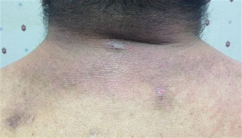 Derm Dx Itchy Rash On Eyelids Chest Back And Hands