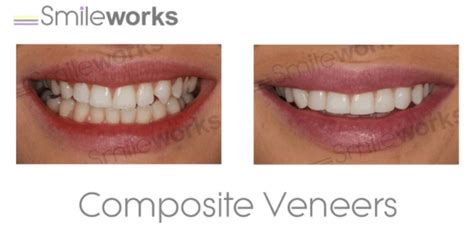 Maybe you would like to learn more about one of these? Composite Bonding: Dentists compare the best (and worst ...