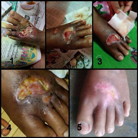 Sistem imun akan menyerang dan membunuh sel di dalam pankreas, organ di adakah kesan penyakit diabetes semasa hamil boleh mempengaruhi bayi dalam kandungan? ABA24 HABLUR : BEBAS DARI PENYAKIT KENCING MANIS DENGAN ...