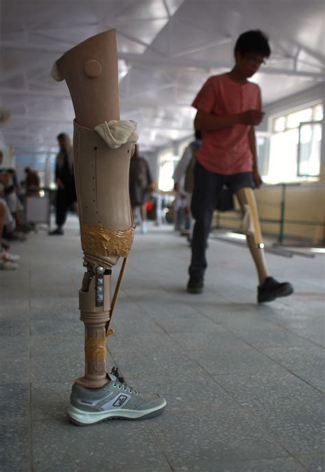 Icrc Orthopedic Center Treats Afghan War Amputees