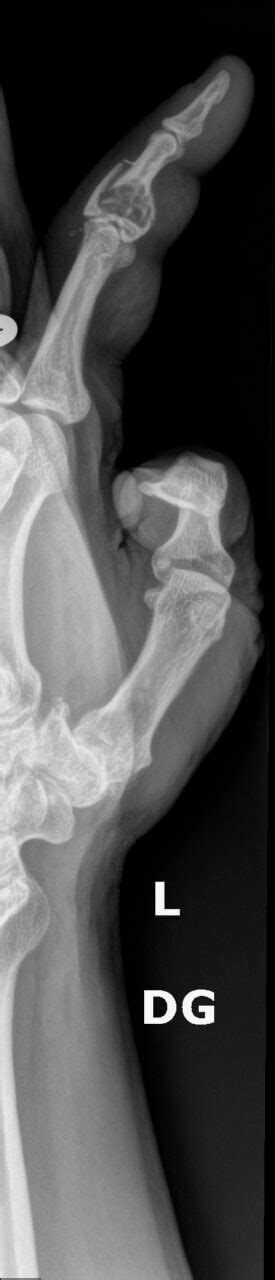 Orthodx Fracture Through A Cyst On Index Finger Clinical Advisor