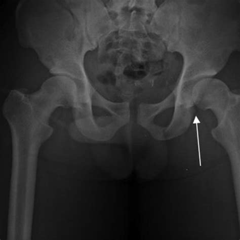 Left Hip Arthroscopy A Intra Articular Hematoma And Rupture Of The