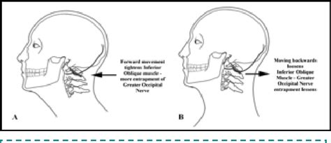Figure 4 From Suboccipital Decompression For Occipital Neuralgia