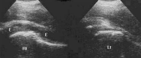 Ultrasound Representation Of Fluid In The Hip Joint E Effusion In The