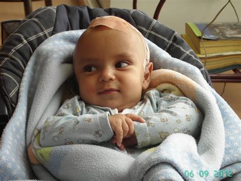 Craniosynostosis Roberts Head Unusual Head Shape In Babies