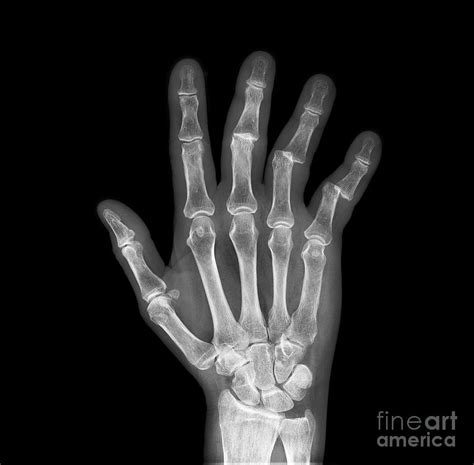 Dislocated Fingers X Ray Photograph By Science Photo Library Fine