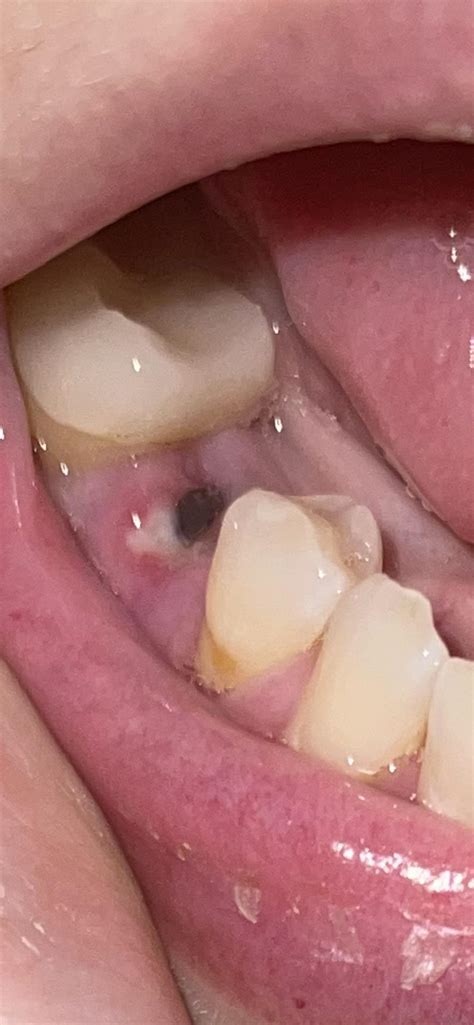 Is this my bone graft showing through my gum? : r/Toothfully