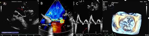 Degenerative Mr Due To Flail Posterior Mitral Valve Leaflet A Tee 4