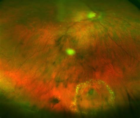 Check spelling or type a new query. Retinal Tear