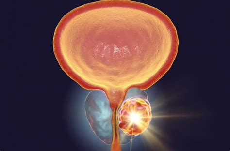 Cancer De La Prostate Urologie Bourgoin