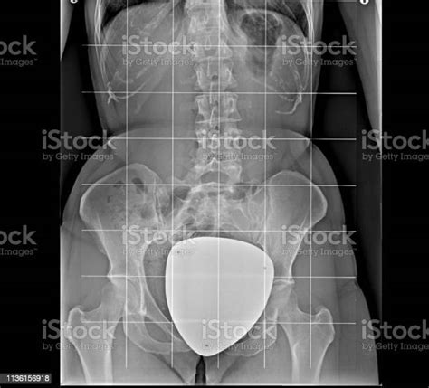 Radiografía De La Pelvis Y Columna Vertebral Vista Frontal Foto De