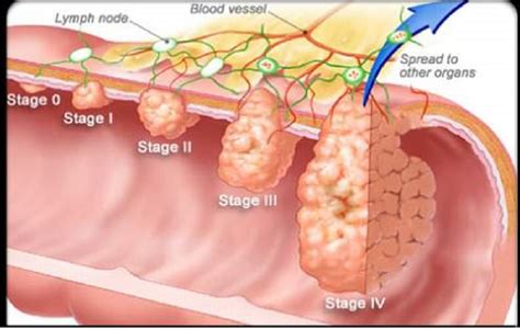 Clinical Research On Lower Gastrointestinal Cancer Cruk Cc