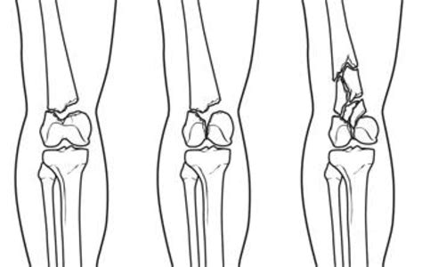 Distal Femur Thighbone Fractures Of The Knee Orthoinfo Aaos