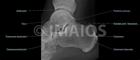 Talus - Calcaneus (-Lateral view) :Neck of talus, Sustentaculum tali